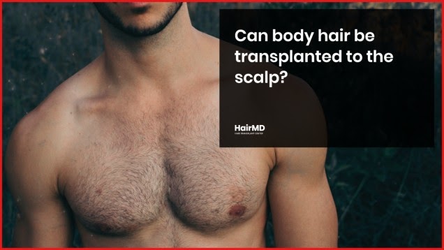Is Body Hair to Scalp Transplant Possible  hairmd
