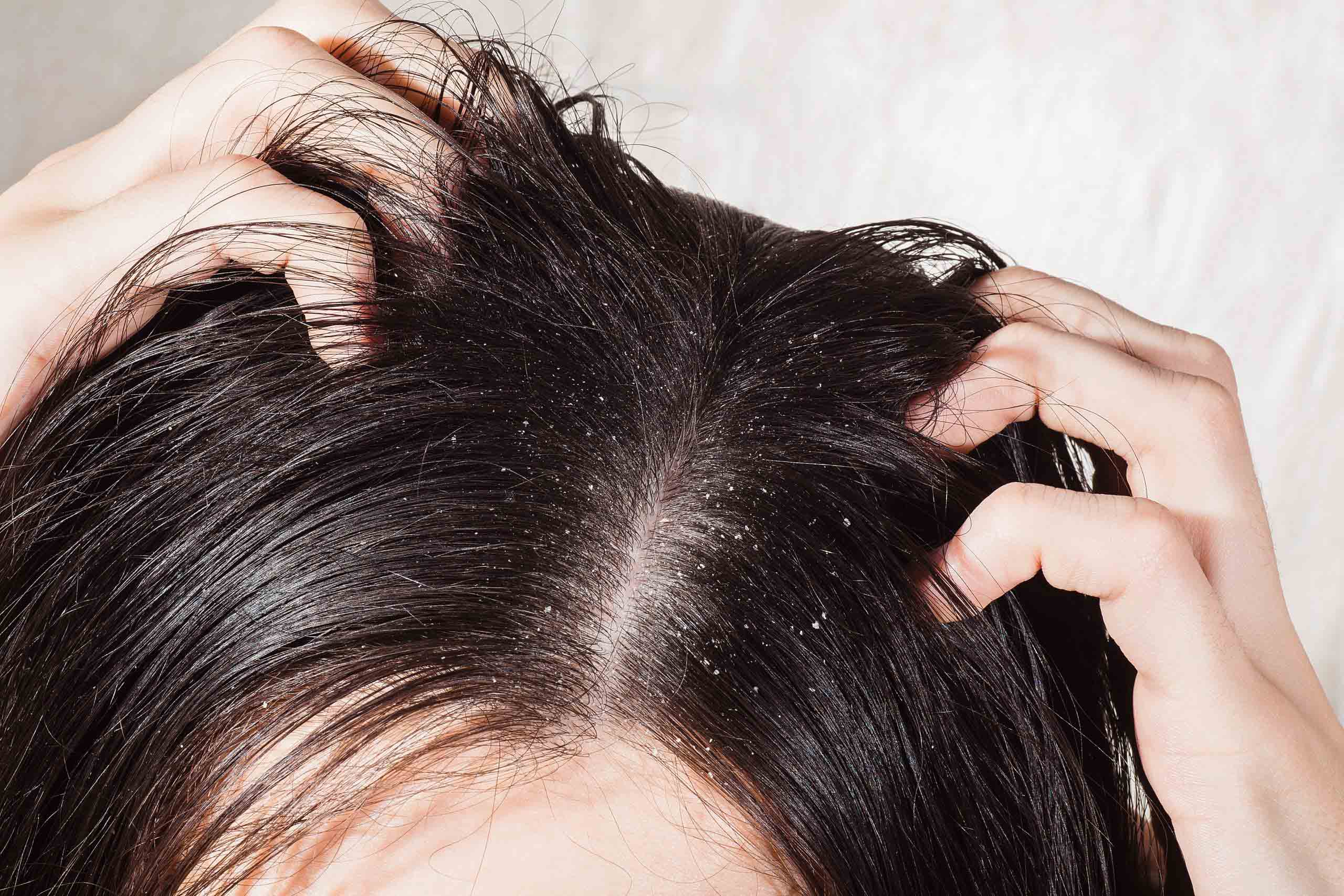dry flaky scalp