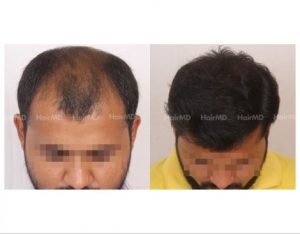 114Hair-Transplant-male-before-after-6000-hair-grafts-28