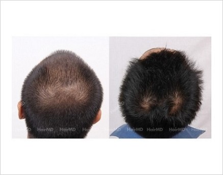 1Hair-Loss-male-before-and-after-result-35