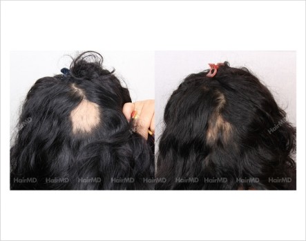 Alopecia-areata-before-after-female-10