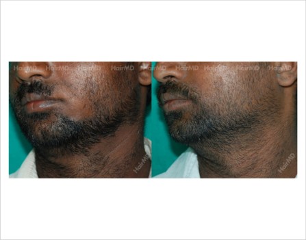 Alopecia-areata-male-beard-before-after-result-21