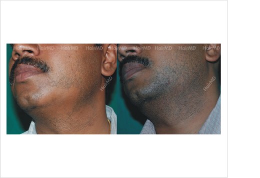 Alopecia-areata-male-beard-before-after-result-24