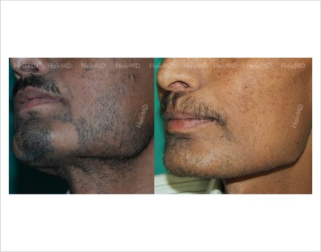 Alopecia-areata-male-beard-before-after-result-32