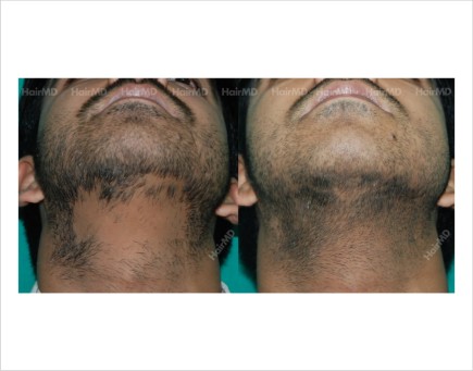 Alopecia-areata-male-chin-before-after-result-27