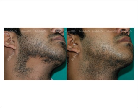 Alopecia-areata-male-chin-before-after-result-28