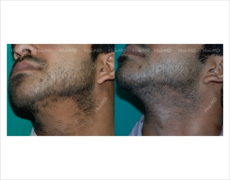 Alopecia-areata-male-chin-before-after-result-29