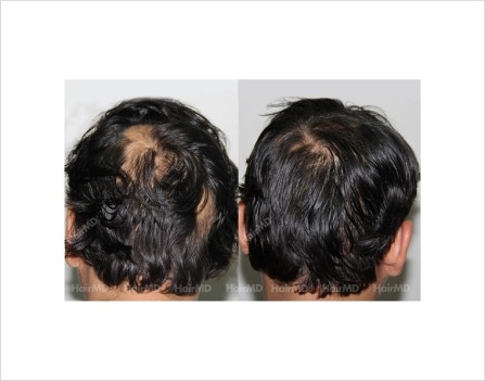 Alopecia-areata-male-scalp-before-after-14