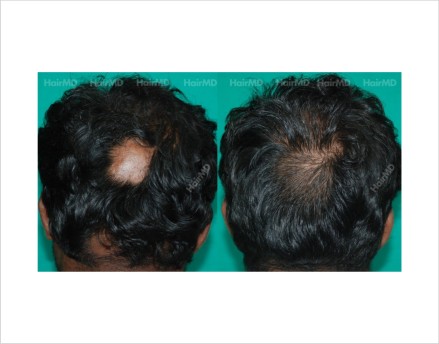 Alopecia-areata-male-scalp-before-after-result-22