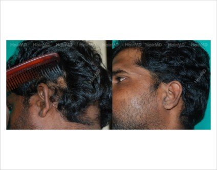 Alopecia-areata-male-scalp-before-after-result-23