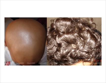 Alopecia-totalis-child-scalp-before-after-result-19