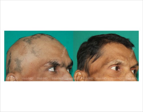 Alopecia-totalis-male-scalp-before-after-result-33