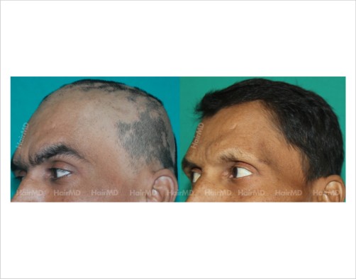 Alopecia-totalis-male-scalp-before-after-result-34