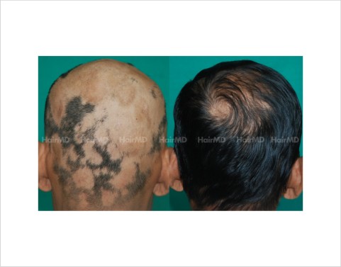 Alopecia-totalis-male-scalp-before-after-result-36