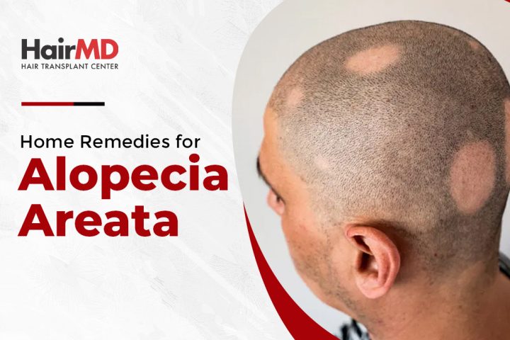 Home Remedies For Alopecia Areata Natural Solutions 