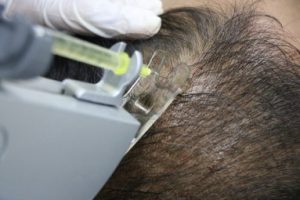 mesotherapy-for-hair-loss-300x200