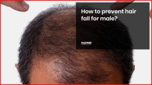 How to prevent hair fall for male