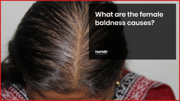 Female Pattern Baldness Causes and Treatment Options