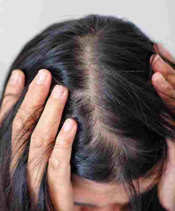 How stress and anxiety can cause hair loss issues