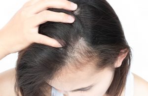 Female pattern baldness