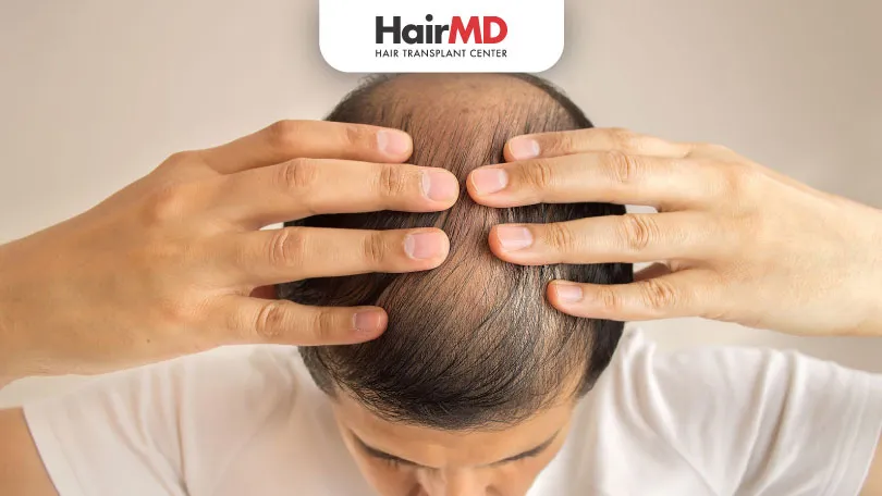 A Complete Guide to Hair Loss: Causes, Treatments, and Prevention Strategies