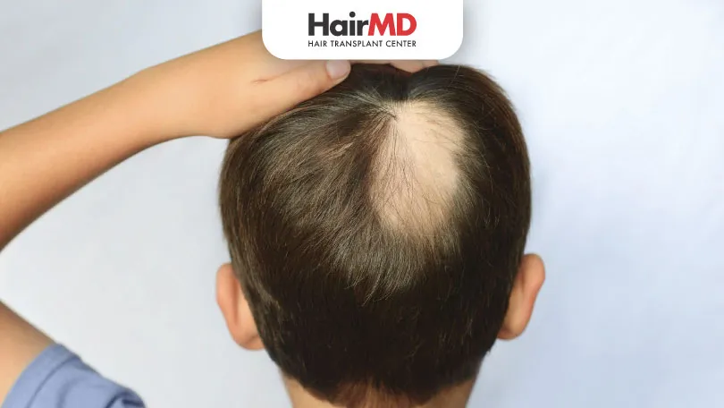 Alopecia Areata in Children: Understanding the Causes of Hair Fall in Kids