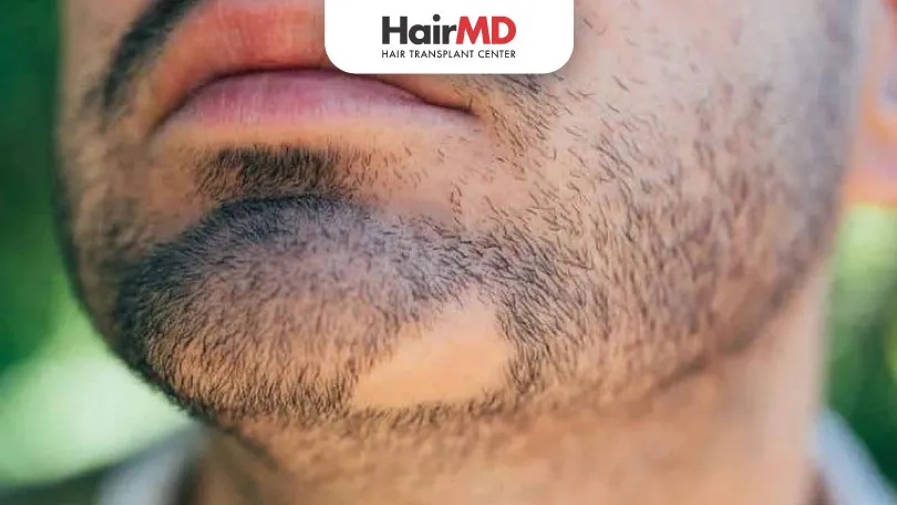 Alopecia Barbae: Causes and Effective Treatments for Bald Patches in Your Beard