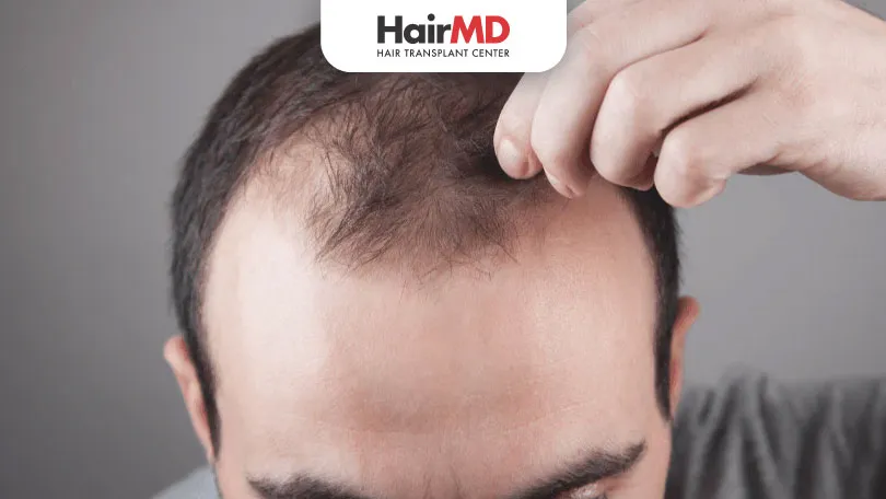 Androgenetic Alopecia in Men: Understanding the Causes and Best Treatment Options