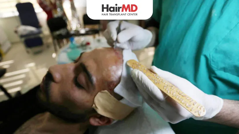 Hair Transplant Costs in India: 5 Crucial Factors Affecting the Cost