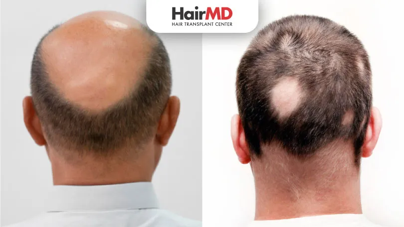 Baldness and Alopecia: Distinguishing Between the Two