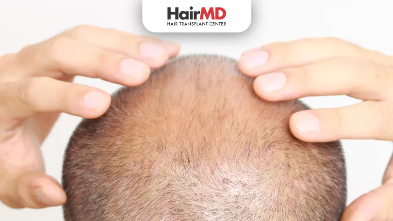 Hair Fall Concerns After Hair Transplant Surgery