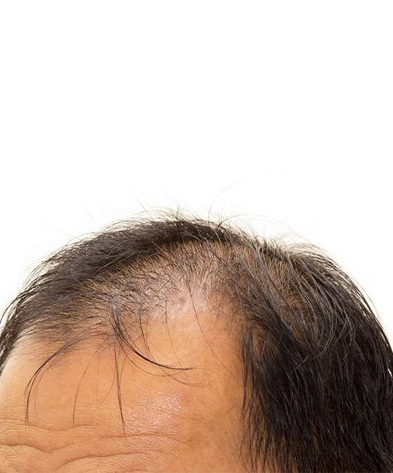 Does work on frontal baldness?