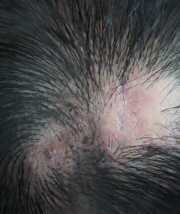 Scarring Alopecia Picture | HairMD, Pune