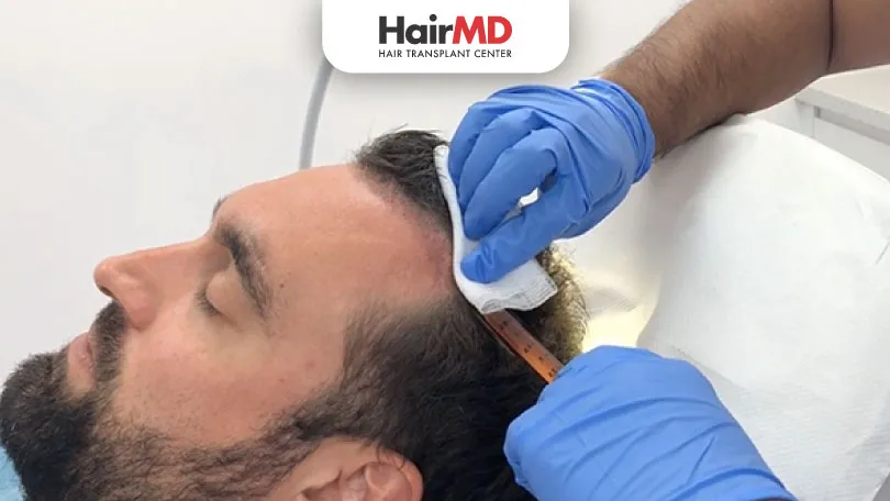 Benefits of PRP after Hair Transplantation