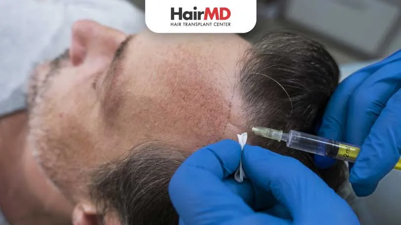 Hair Transplant Myths & Facts