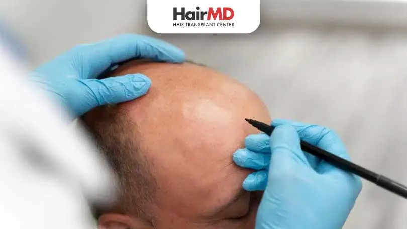 FUE vs FUT vs DHI: Best Hair Transplant Method?