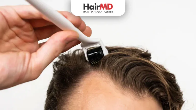 Dermaroller Treatment for Hair Loss