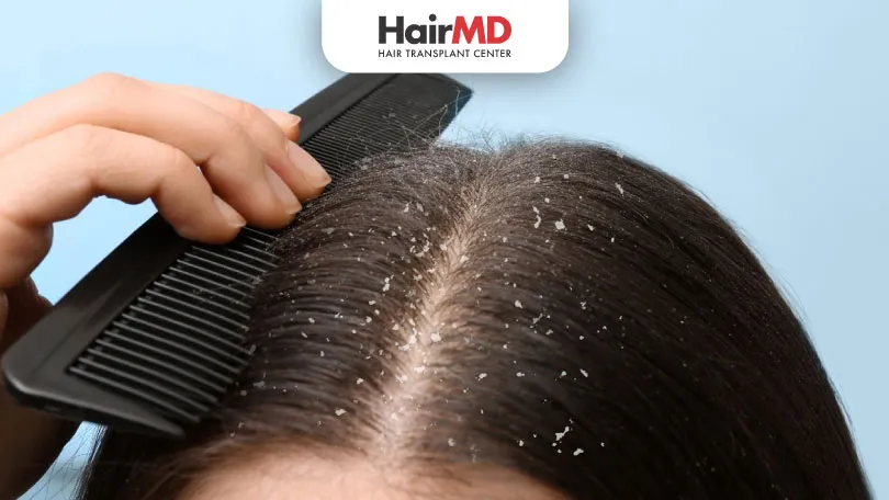 Types of Dandruff and their Treatment