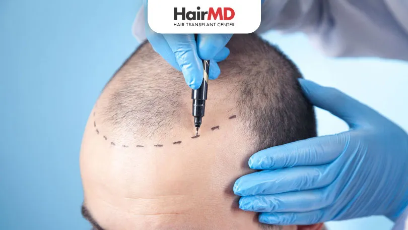 Types of Hair Transplant Treatments