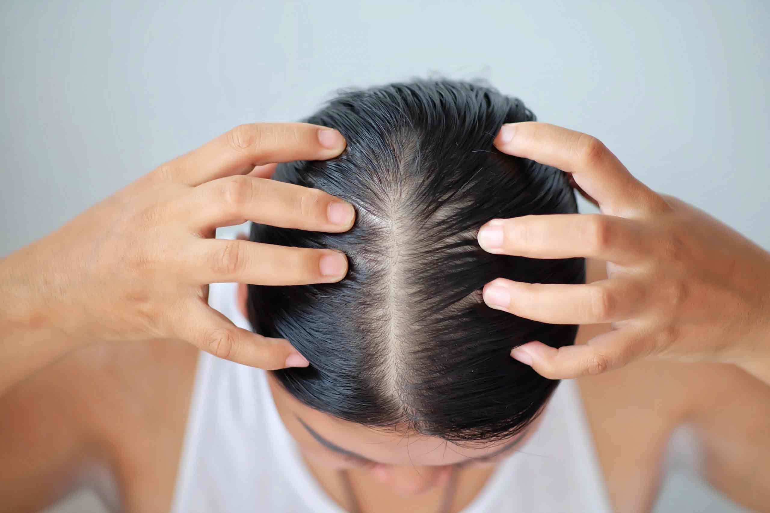 Menopause and Hair Loss Symptoms Causes and Treatment