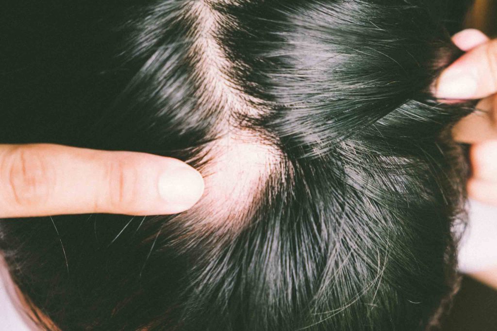 How To Grow Hair On Bald Spot?