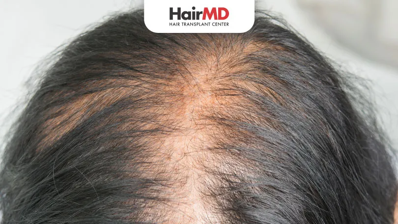 Does Finasteride Work for Female Hair Loss?