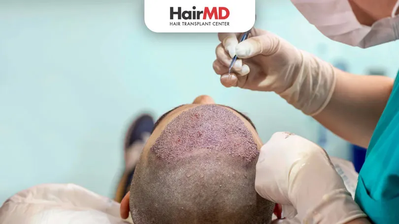 Does Hair Transplant Procedure Hurt?