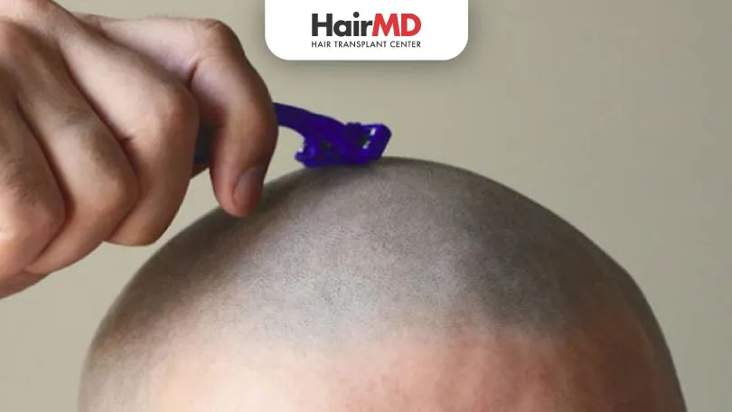 Does Hair Fall Stop After Shaving Head?