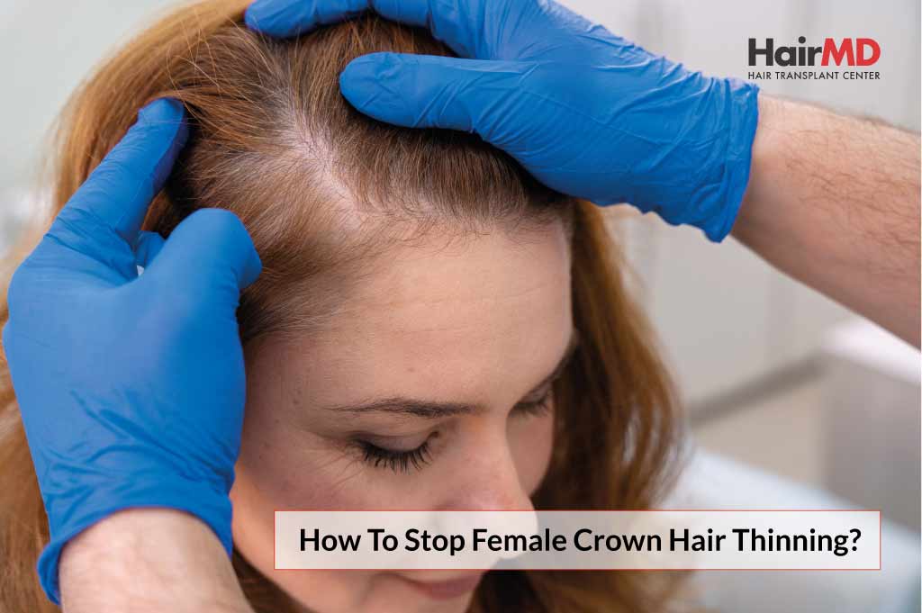 female pattern baldness crown