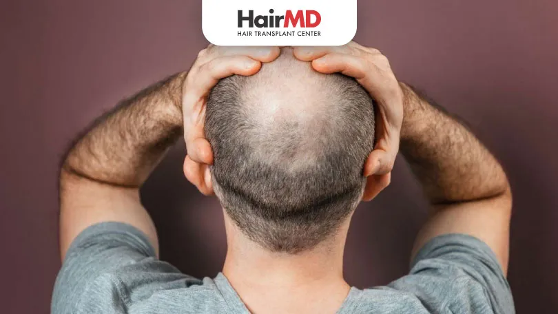 Can Metoprolol Cause Hair Loss ?