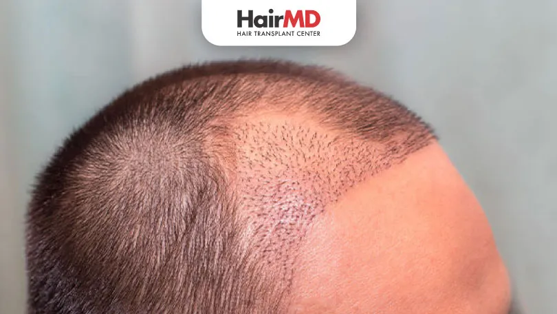 Does Transplanted Hair Fall Out After Surgery HairMD Pune