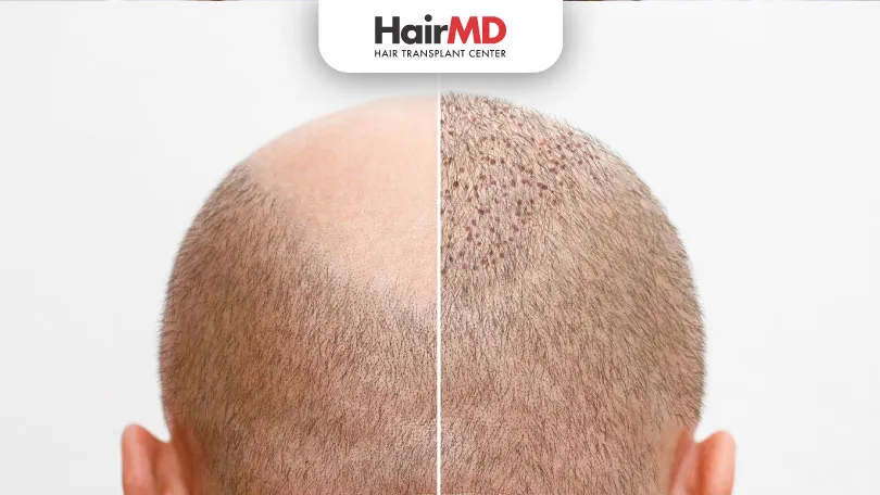 Do’s & Don’ts After Hair Transplant