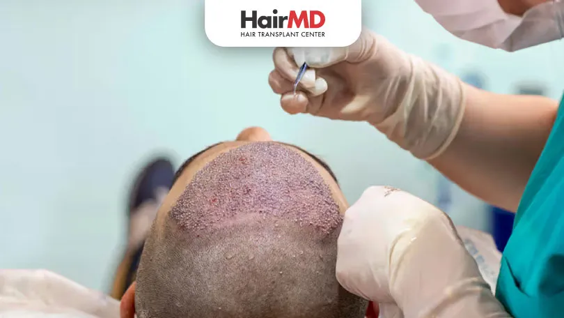 Hair Transplant: केसांचे प्रत्यारोपण कितपत प्रभावी आहे?