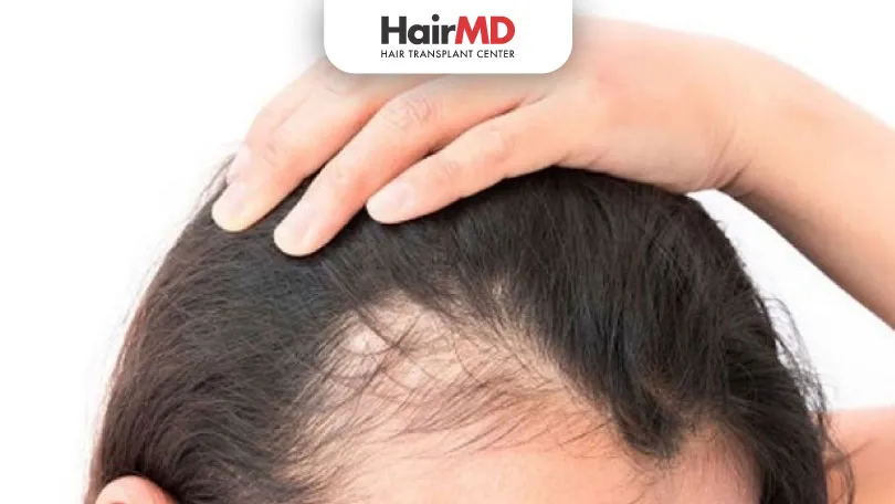 Female Pattern Baldness: Causes & Treatment